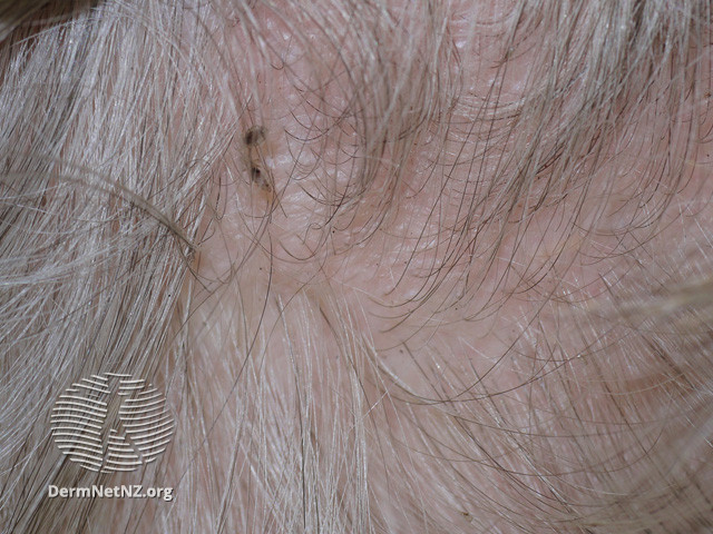 File:Head lice (DermNet NZ site-age-specific-head-lice-19).jpg
