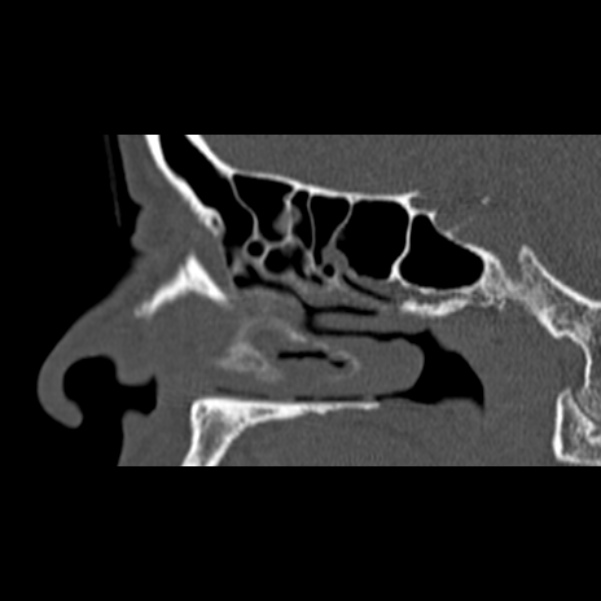 Nasal septal perforation (Radiopaedia 25030-25289 Sagittal bone window 16).jpg