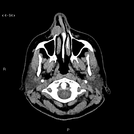 Nasolabial cyst (Radiopaedia 75125-86194 Axial non-contrast 56).jpg