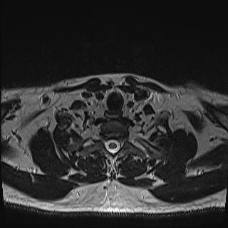 Nasopharyngeal carcinoma with perineural spread (Radiopaedia 55030-61380 Axial T2 80).jpg