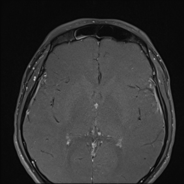 Nasopharyngeal carcinoma with skull base invasion (Radiopaedia 53415-59485 Axial T1 C+ fat sat 8).jpg