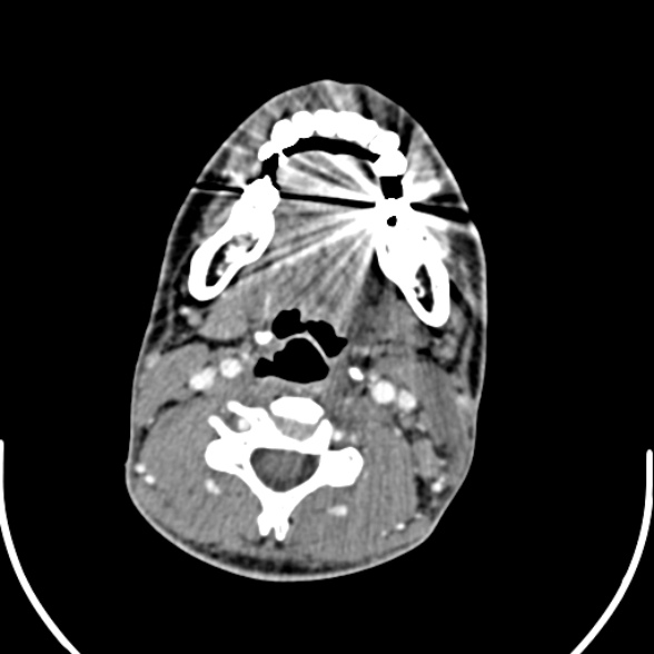 File:Nasopharyngeal carcinoma with skull base invasion (Radiopaedia 53415-59705 A 117).jpg