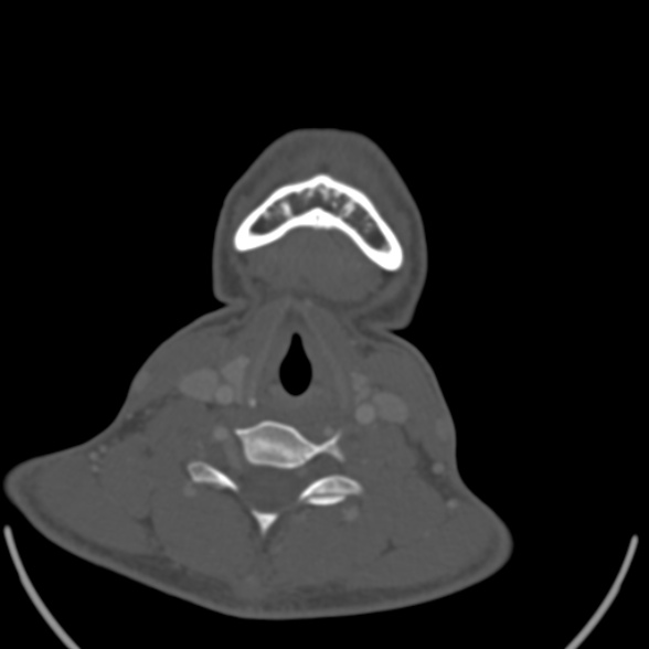 File:Nasopharyngeal carcinoma with skull base invasion (Radiopaedia 53415-59705 Axial bone window 150).jpg