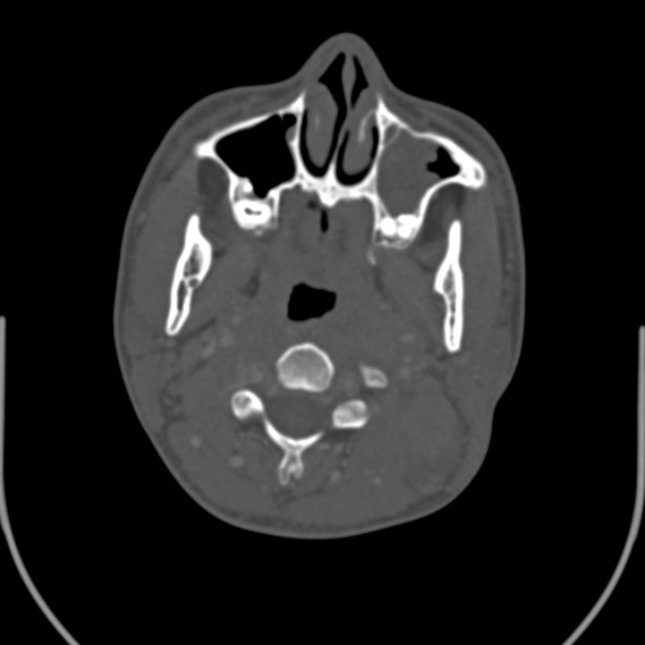 Nasopharyngeal carcinoma with skull base invasion (Radiopaedia 53415-59705 Axial bone window 74).jpg