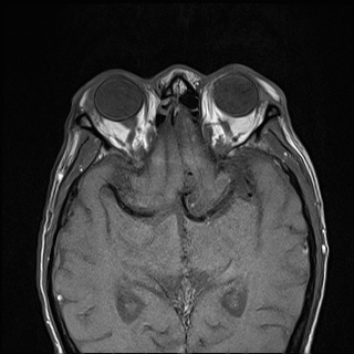 Nasopharyngeal carcinoma with skull base invasion (Radiopaedia 59258-66600 B 4).jpg