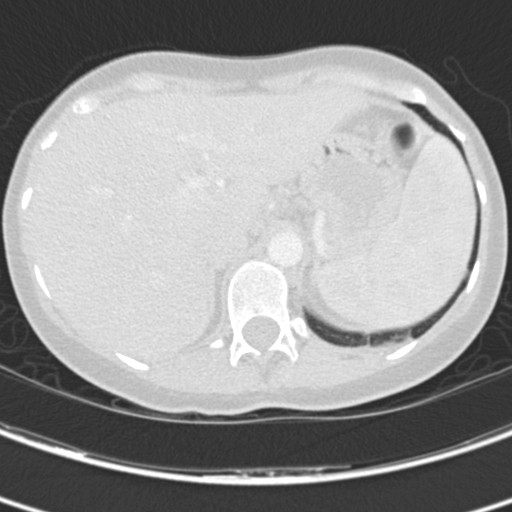 File:Necrobiotic pulmonary nodules - Crohn disease (Radiopaedia 20723-20631 Axial lung window 135).jpg
