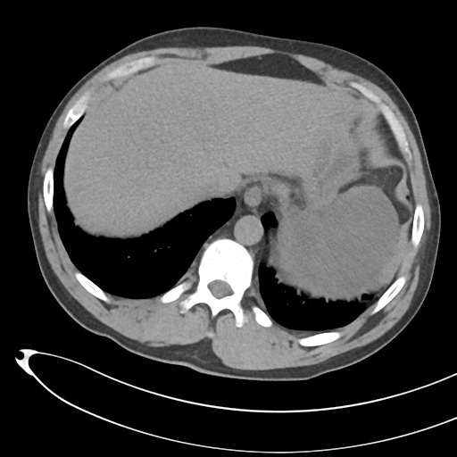 File:Necrotizing pancreatitis with acute necrotic collections (Radiopaedia 38829-41012 Axial non-contrast 14).png