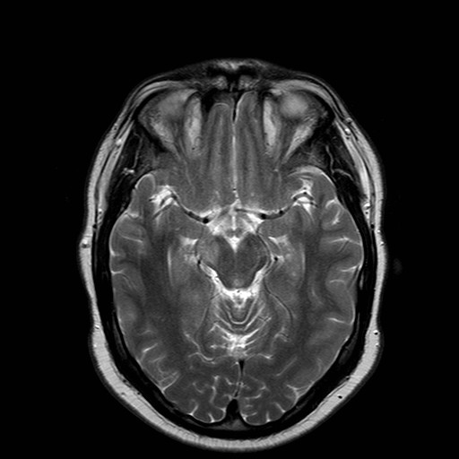 File:Neuro-Behcet's disease (Radiopaedia 21557-21505 Axial T2 9).jpg