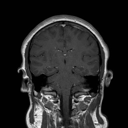 File:Neuro-Behcet's disease (Radiopaedia 21557-21505 Coronal T1 C+ 12).jpg