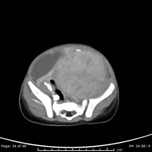 File:Neuroblastoma (Radiopaedia 41472-44355 A 34).jpg