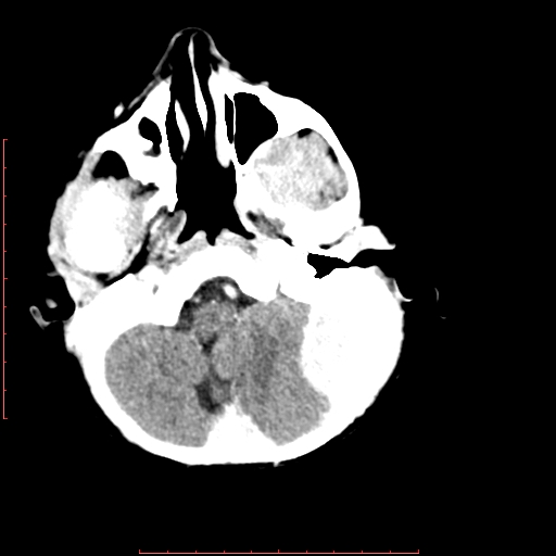 File:Neuroblastoma skull metastasis (Radiopaedia 56053-62683 Axial +Contrast 4).jpg
