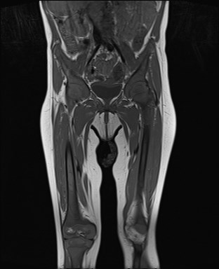 File:Neuroblastoma with bone metastases (Radiopaedia 67080-76414 Coronal T1 10).jpg