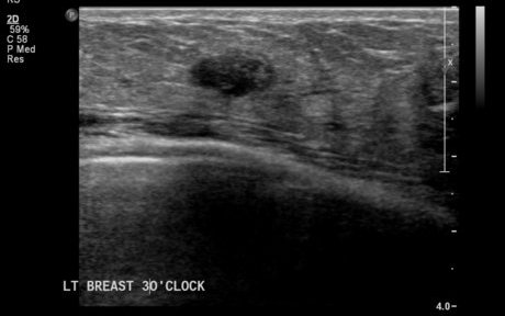 File:Neurofibromatosis of breast (Radiopaedia 5921-7462 D 1).jpg