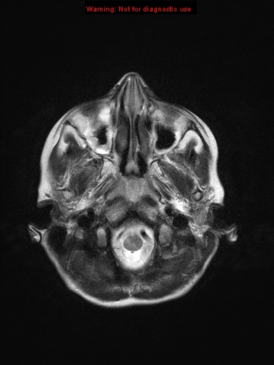 File:Neurofibromatosis type 1 with optic nerve glioma (Radiopaedia 16288-15965 Axial T2 22).jpg