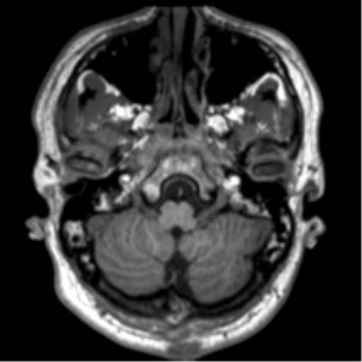 File:Neurofibromatosis type 2 (Radiopaedia 44936-48838 Axial T1 17).png