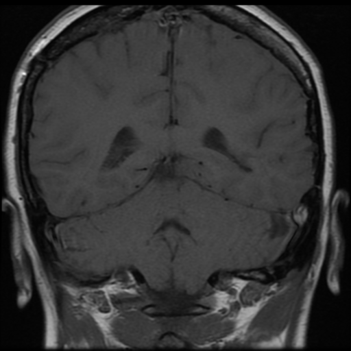 File:Neurofibromatosis type 2 (Radiopaedia 45229-49251 Coronal T1 2).png