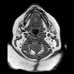 File:Neurofibromatosis type 2 (Radiopaedia 8713-9518 Axial T1 29).jpg