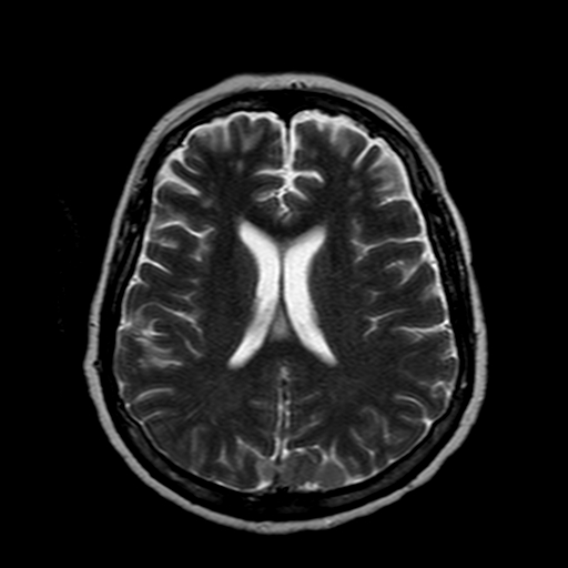 File:Neurofibromatosis type 2 (Radiopaedia 8713-9518 Axial T2 10).jpg