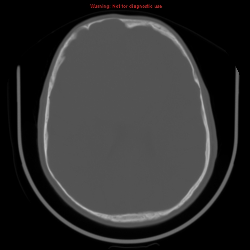 File:Neurofibromatosis type 2 (Radiopaedia 8953-9732 Axial bone window 22).jpg