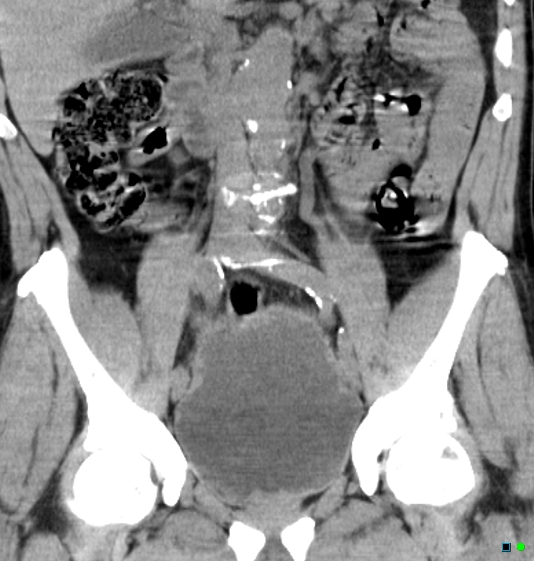 File:Neurogenic bladder - CT findings (Christmas tree bladder) (Radiopaedia 26995-27174 Coronal non-contrast 8).jpg