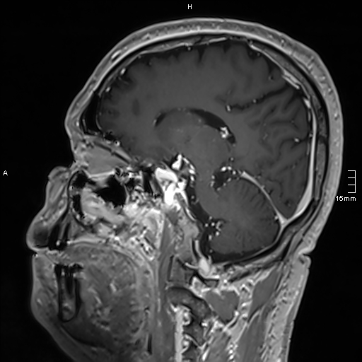 Neurosarcoidosis - involvement of the mesial temporal lobes (Radiopaedia 67429-76820 Sagittal T1 C+ 99).jpg