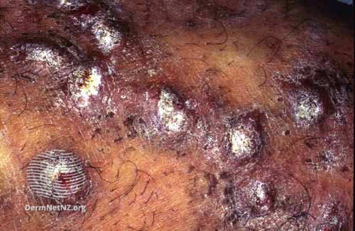 File:Nodular prurigo (DermNet NZ dermatitis-pn1).jpg