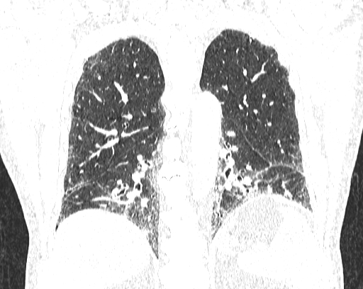 Non-specific interstitial pneumonia (NSIP) (Radiopaedia 68599-78228 Coronal lung window 66).jpg
