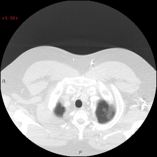 File:Non-specific interstitial pneumonitis (Radiopaedia 27044-27222 Axial lung window 50).jpg