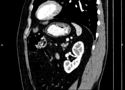 Non-syndromic pancreatic endocrine tumor (Radiopaedia 86958-103178 E 73).jpg