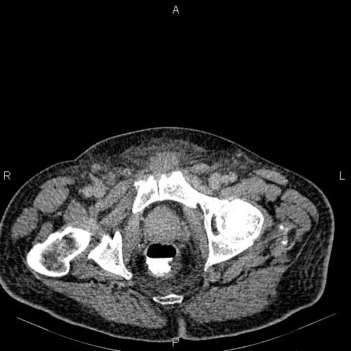 Non Hodgkin lymphoma in a patient with ankylosing spondylitis (Radiopaedia 84323-99621 Axial C+ delayed 81).jpg