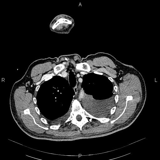 File:Non Hodgkin lymphoma in a patient with ankylosing spondylitis (Radiopaedia 84323-99621 B 9).jpg