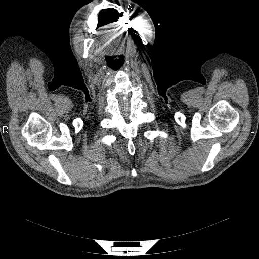 File:Non Hodgkin lymphoma in a patient with ankylosing spondylitis (Radiopaedia 84323-99624 Axial non-contrast 2).jpg