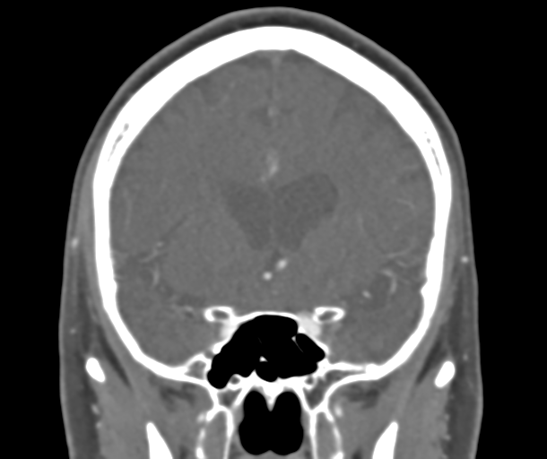 File:Normal CTA head (Radiopaedia 40801-43464 B 39).png