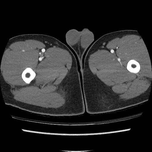 File:Normal CT angiogram of pelvis (Radiopaedia 45390-49430 A 66).jpg