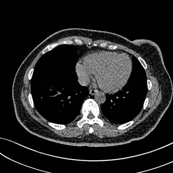 Normal CT chest- adult female (Radiopaedia 52522-58428 Axial non-contrast 90).jpg