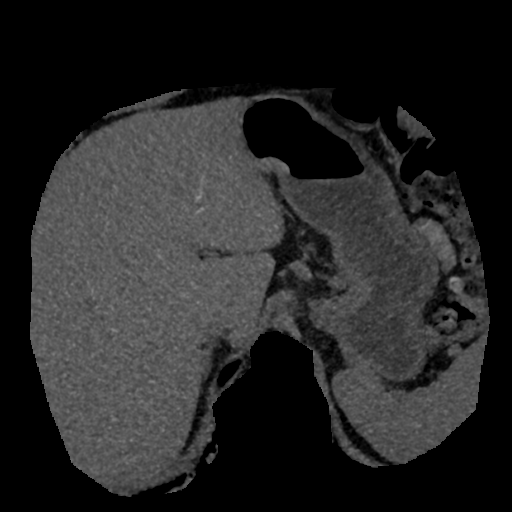 File:Normal CT intravenous cholangiogram (Radiopaedia 38199-40208 Axial IVC (MIP) 67).png