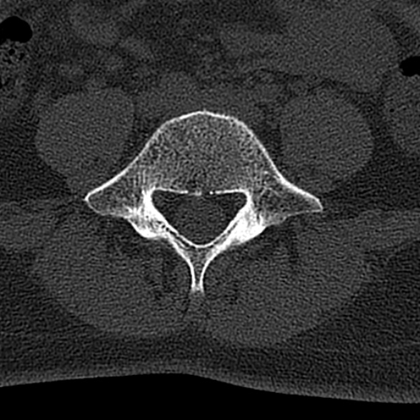File:Normal CT lumbar spine (Radiopaedia 53981-60118 Axial bone window 57).jpg