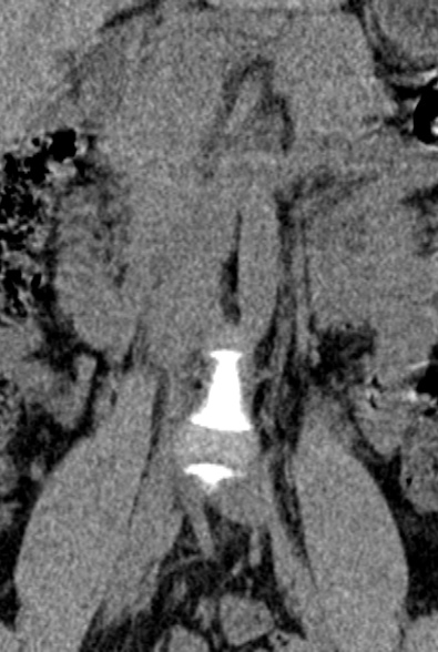 Normal CT lumbar spine (Radiopaedia 53981-60118 F 3).jpg