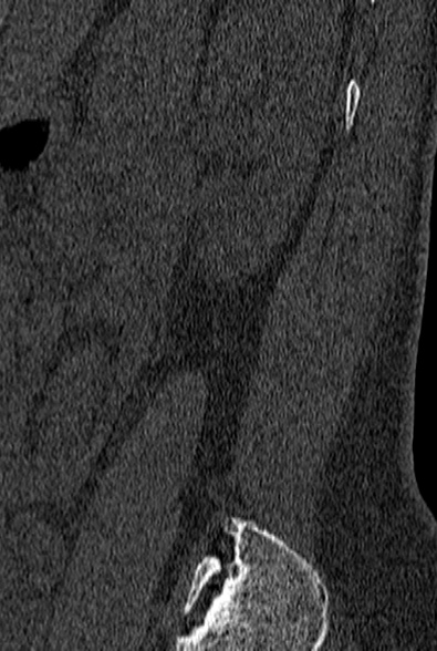 File:Normal CT lumbar spine (Radiopaedia 53981-60118 Sagittal bone window 90).jpg