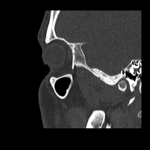 Normal CT paranasal sinuses (Radiopaedia 42286-45390 Sagittal bone window 13).jpg