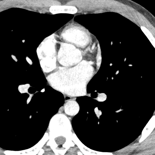 File:Normal CT pulmonary veins (pre RF ablation) (Radiopaedia 41748-44702 A 145).png