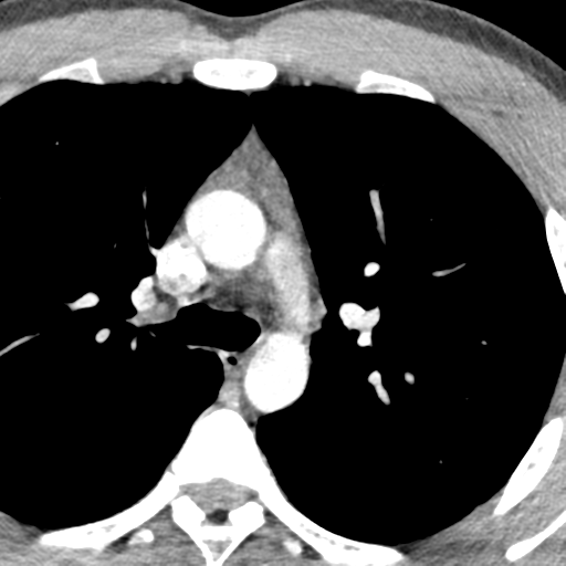 File:Normal CT pulmonary veins (pre RF ablation) (Radiopaedia 41748-44702 A 36).png
