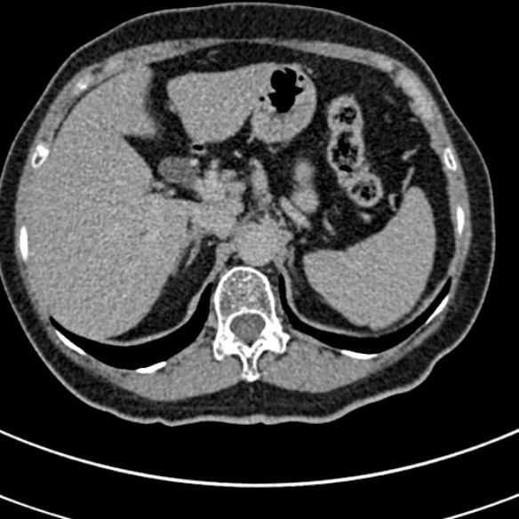 File:Normal CT split bolus study of the renal tract (Radiopaedia 48631-53634 Axial split bolus 14).jpg