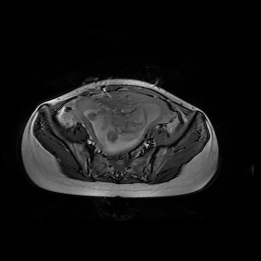 File:Normal MRI abdomen in pregnancy (Radiopaedia 88001-104541 Axial Gradient Echo 42).jpg