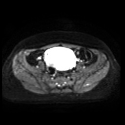 Normal MRI abdomen in pregnancy (Radiopaedia 88005-104548 Axial DWI 25).jpg