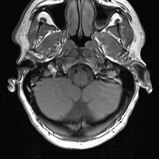 File:Normal MRI cervical spine (infection protocol) (Radiopaedia 53916-60039 Axial 4).png