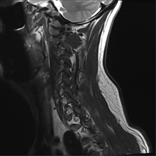 File:Normal MRI cervical spine (infection protocol) (Radiopaedia 53916-60039 Sagittal T2 15).png
