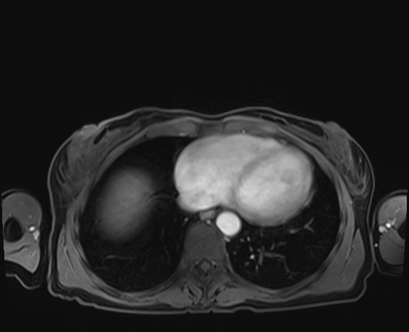 Normal adrenal glands MRI (Radiopaedia 82017-96004 K 2).jpg