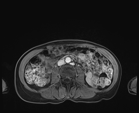 Normal adrenal glands MRI (Radiopaedia 82017-96004 K 56).jpg