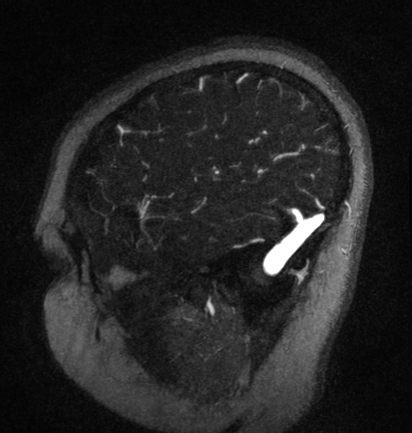 Normal brain MRI and venogram (Radiopaedia 39554-41862 Sagittal MRV 9).jpg